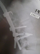 Want to Talk About Scoliosis?