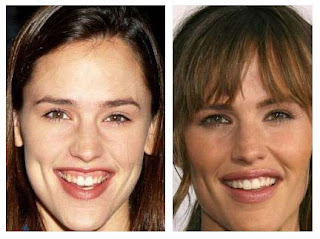 Plastic Surgery Before After: Jennifer Garner Plastic Surgery