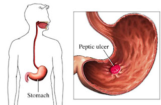  stomach-ulcer-treatm