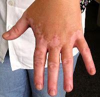 vitiligo white patches)