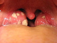 white spots on the tonsils due to infection