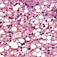 liver steatosis