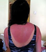 sunburn
