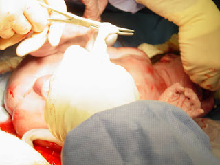 From my cesarean birth photos