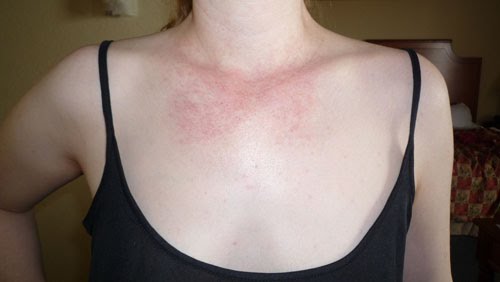 itchy chest rash #11