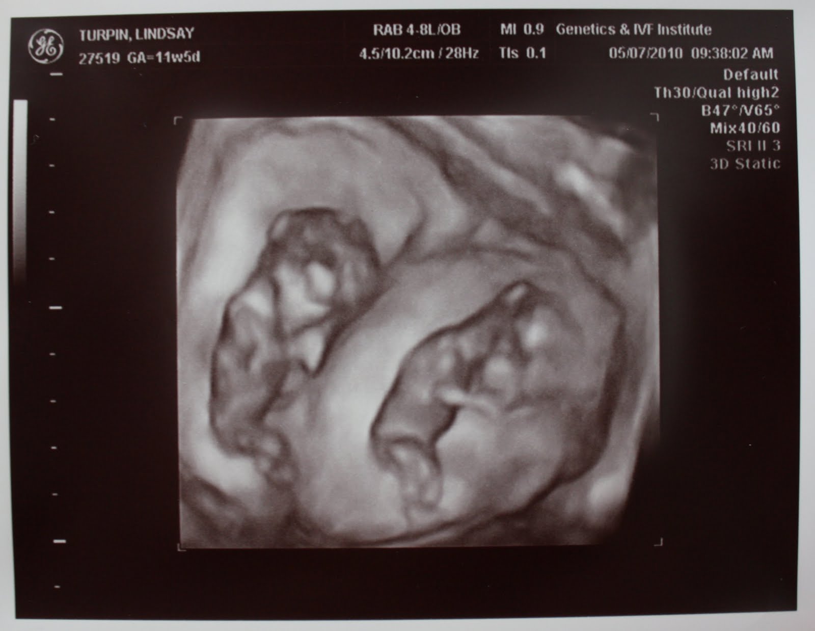 Adventures in Baby Making: 12 weeks ultrasound