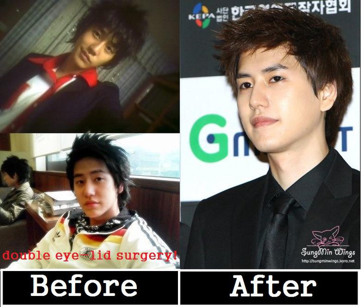 Super Junior Plastic Surgery Before And After