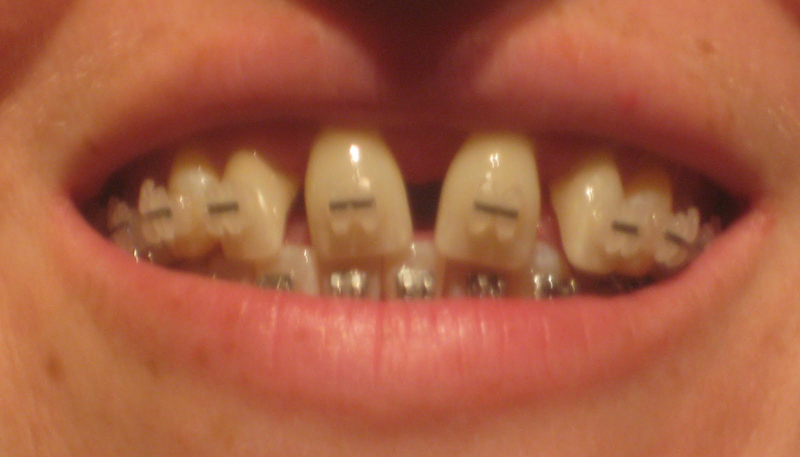 SARPE, Jaw Surgery and Adult Braces, Oh My! Silver power chains!