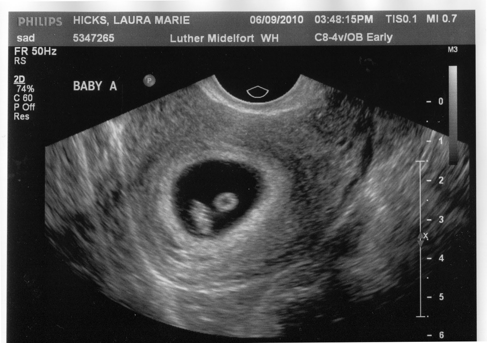 Беременность 4 недели видна на узи. УЗИ беременности на ранних сроках. Эмбрион на УЗИ на раннем сроке. УЗИ по беременности на ранних сроках.