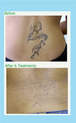 Browse Tattoos: How big is a square inch tattoo removal?