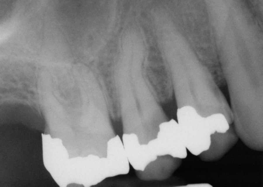 Case studies in dentistry 3 missing ML cusp and large amalgam; 5