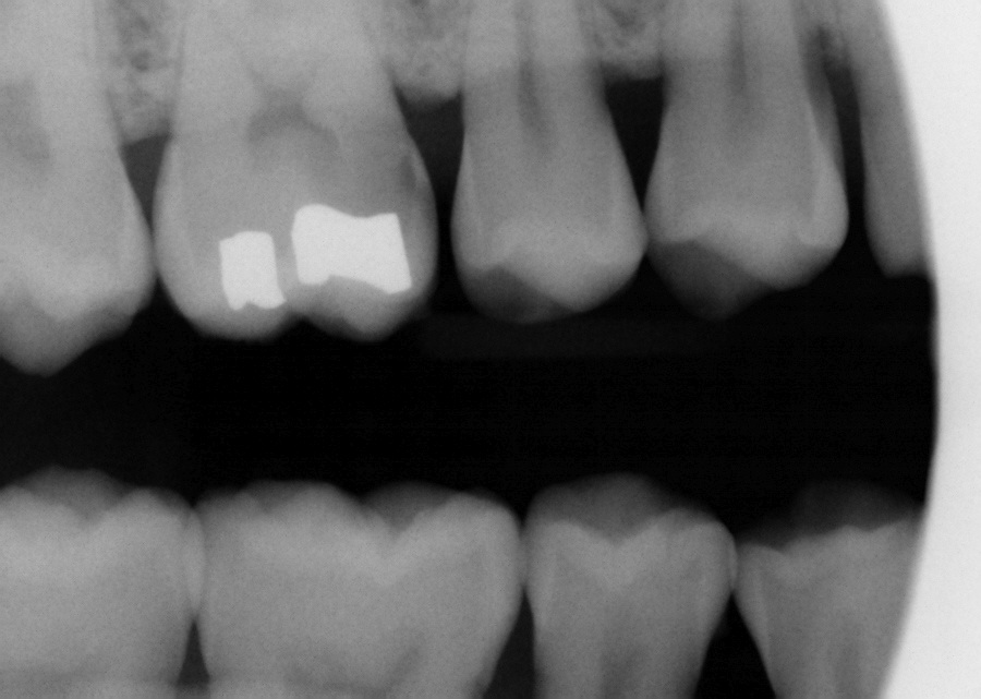 Case studies in dentistry 3 deep caries, indirect pulp cap placed