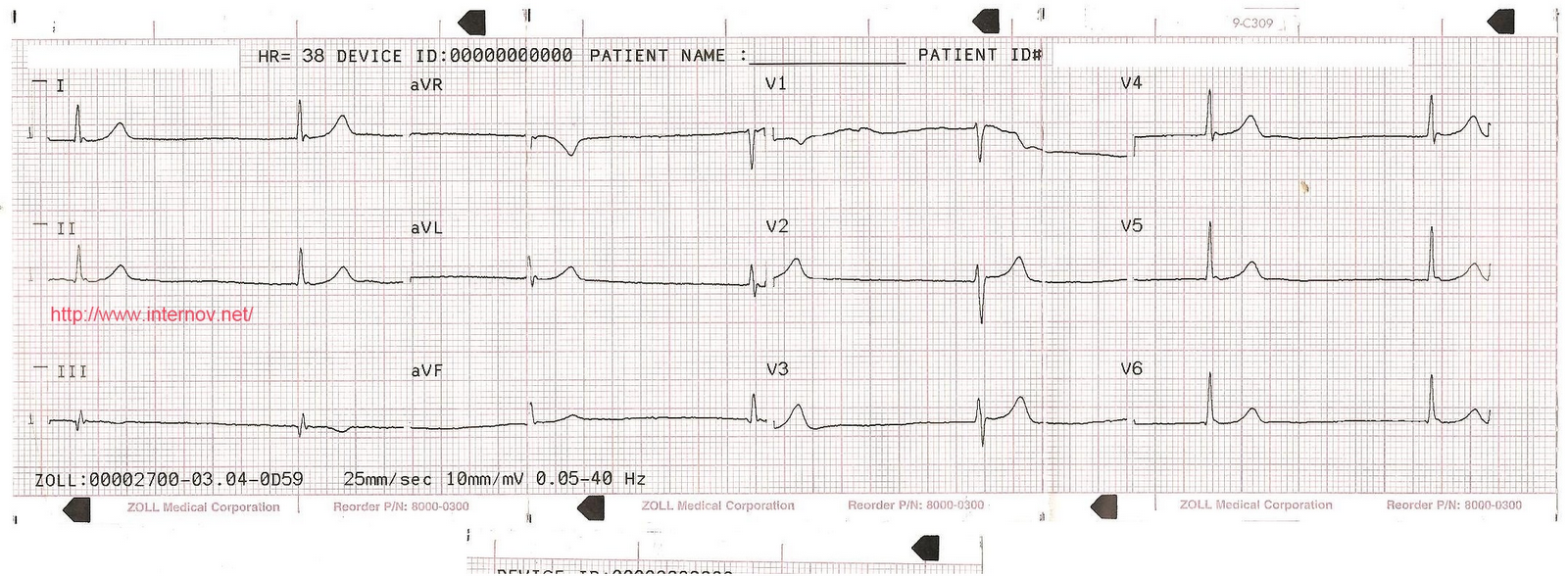 полная атриовентрикулярная блокада на экг. брадикардия синусовая аритмия экг. брадикардии блокады. синусовая брадикардия схема экг. синусовая брадикардия экг проявления.