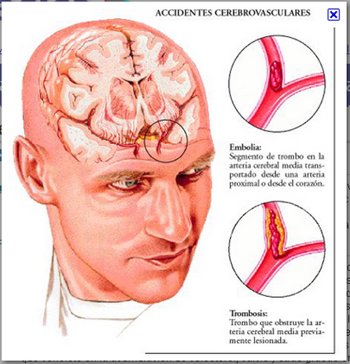 vínculo de diabetes con accidente cerebrovascular