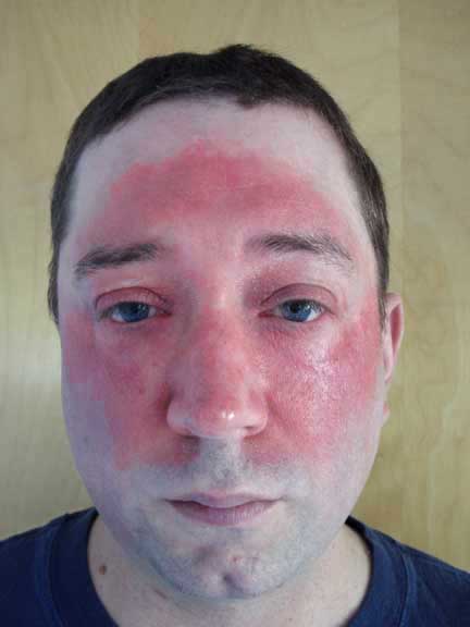 TOPICAL CORTICOSTEROID ABUSE ON THE FACE: A PROSPECTIVE ...