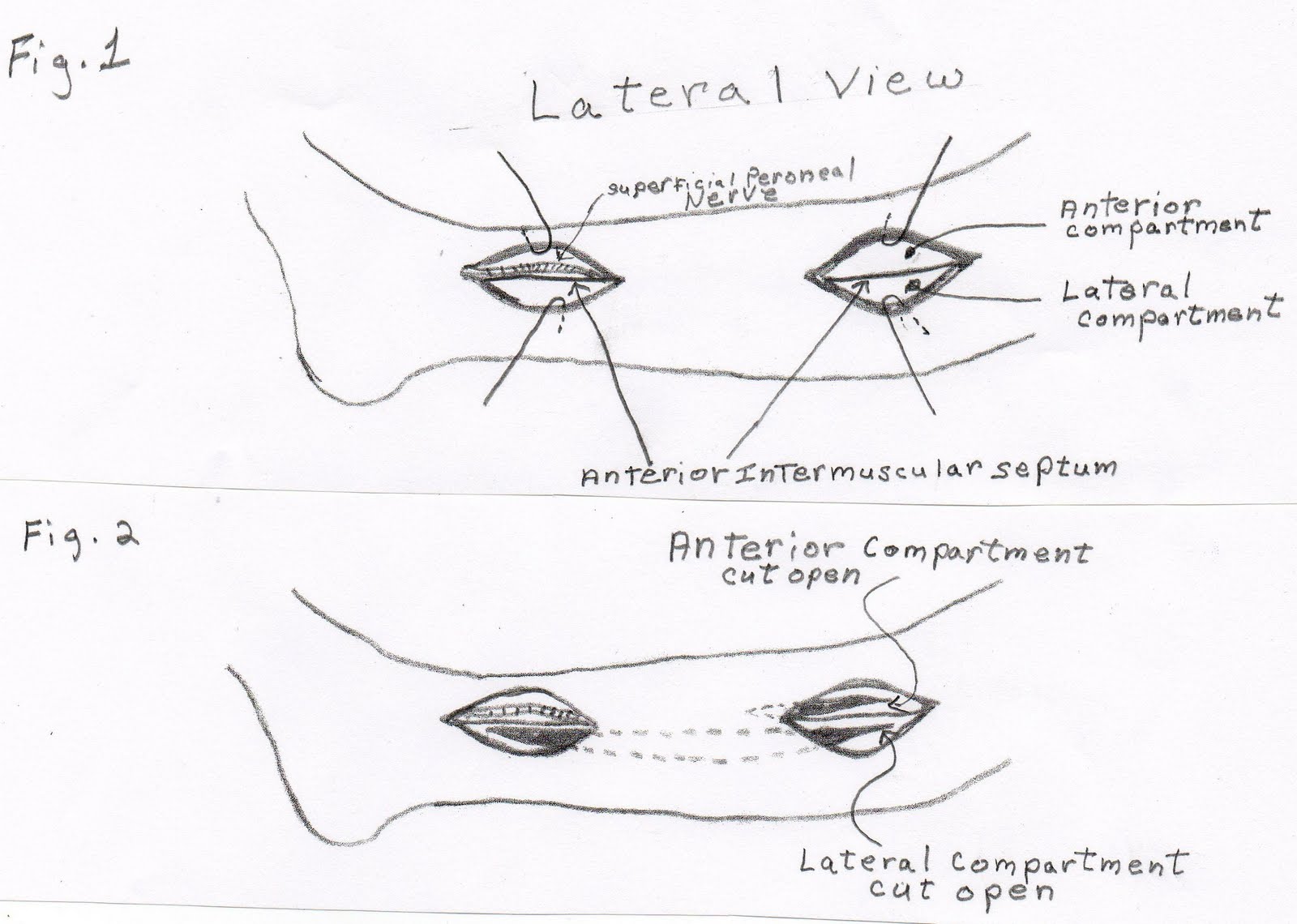 The Injured Athlete Chronic Exertional Compartment Syndrome