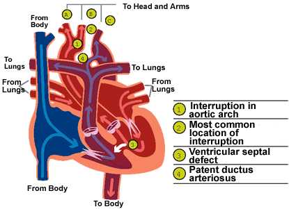 Interrupted aortic arch type c collateral vessels - Wascm