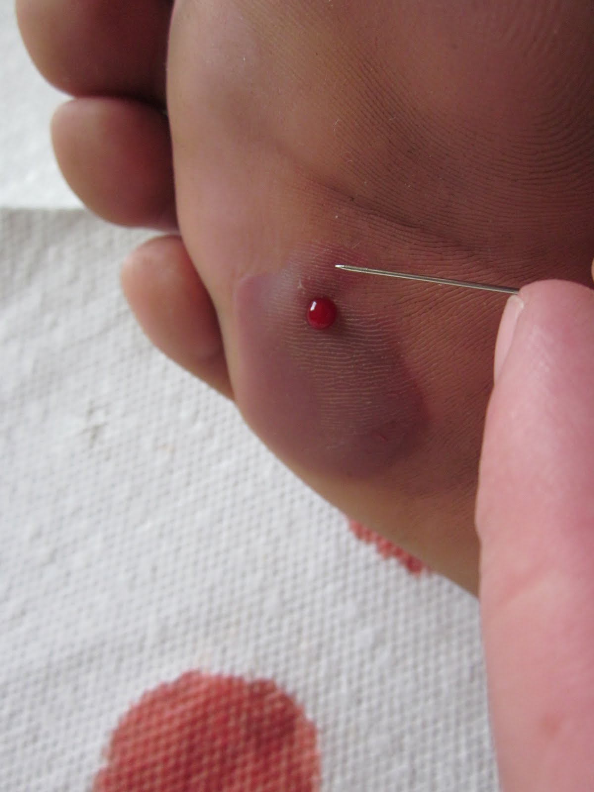 Barefoot Chronicles Proper Care and Feeding of Blisters