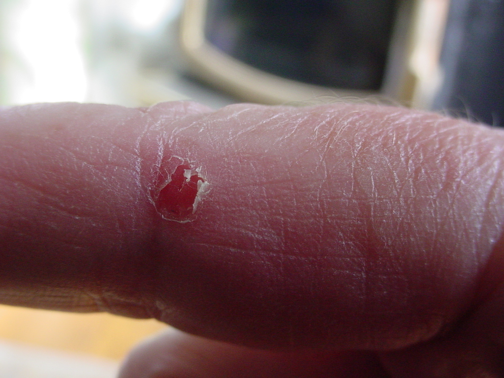skin peeled off finger #9