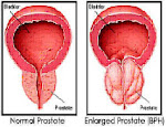 Prostate Problem