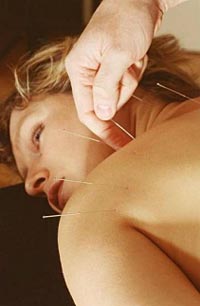 [akupunktur-tedavisi-.jpg]