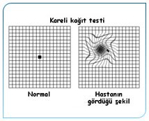 [Makula+Dejenerasyonu+2.jpg]
